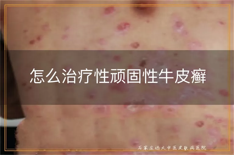 怎么治疗性顽固性牛皮癣