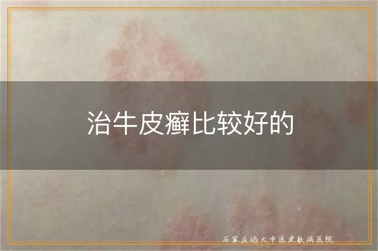 治牛皮癣比较好的