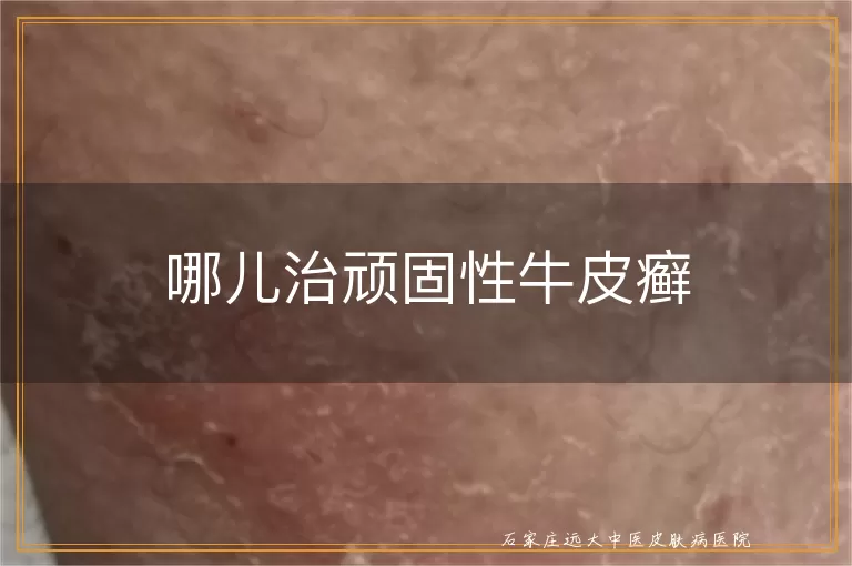哪儿治顽固性牛皮癣