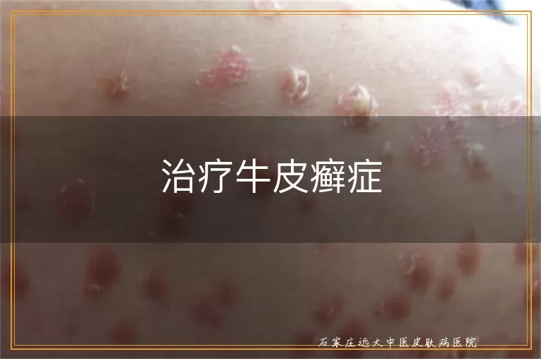治疗牛皮癣症