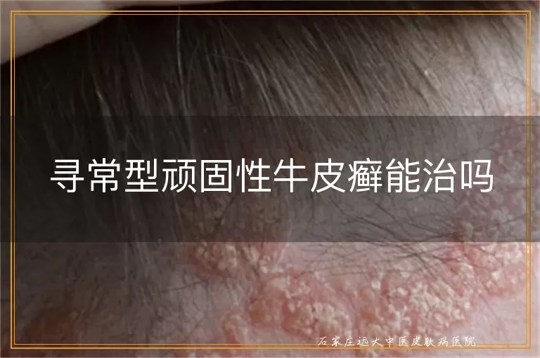 寻常型顽固性牛皮癣能治吗