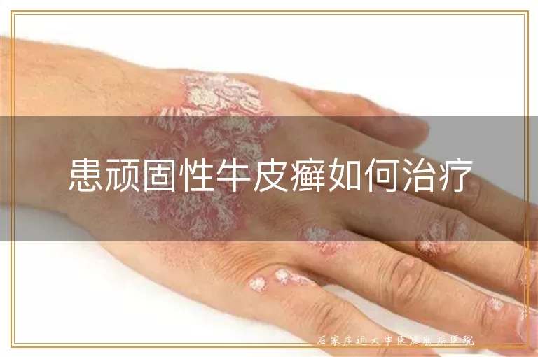 患顽固性牛皮癣如何治疗