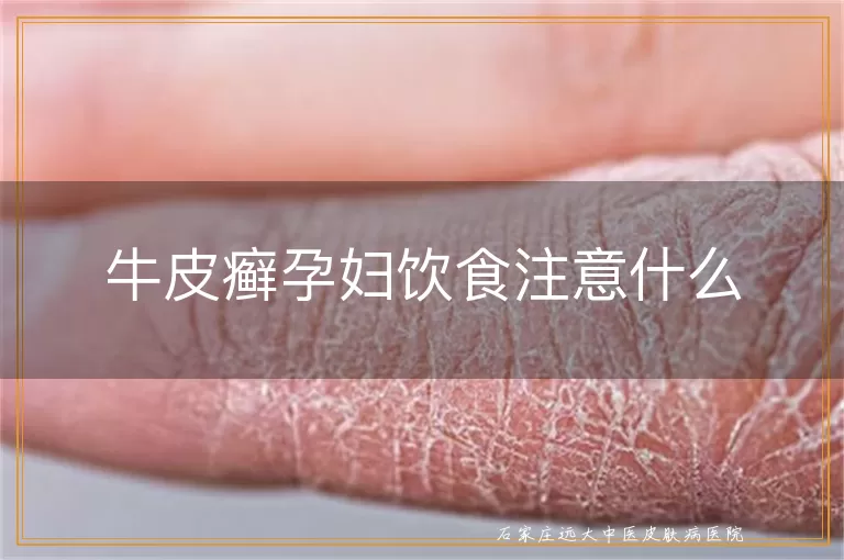 牛皮癣孕妇饮食注意什么