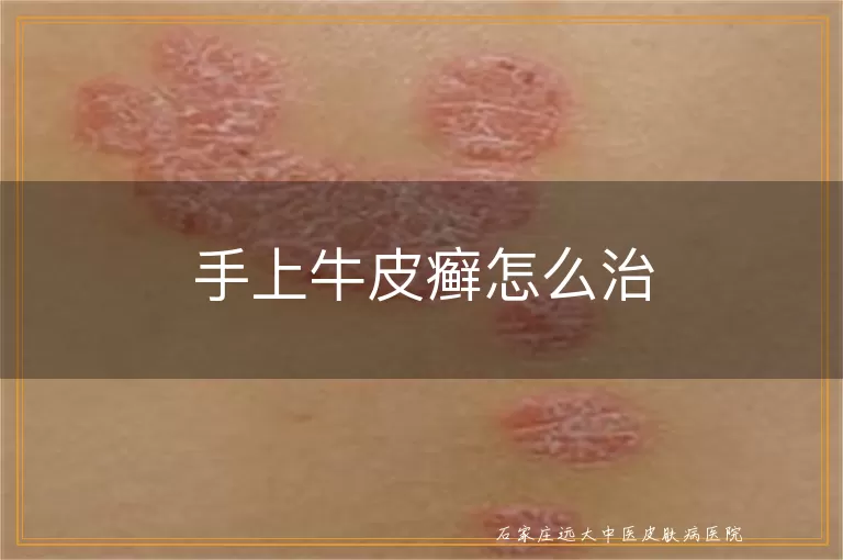 手上牛皮癣怎么治