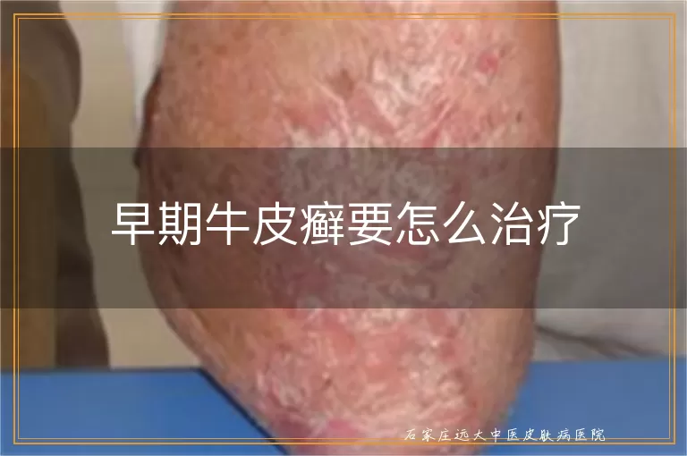 早期牛皮癣要怎么治疗