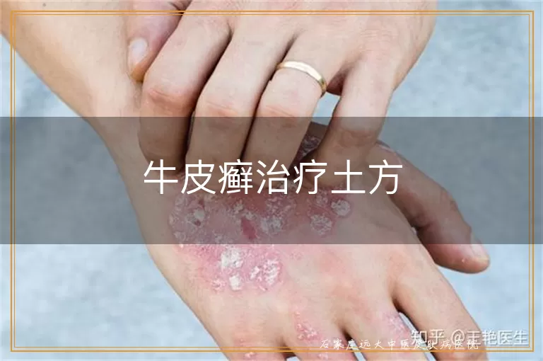 牛皮癣治疗土方