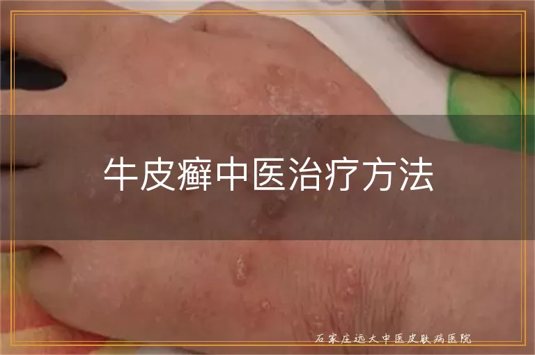 牛皮癣中医治疗方法