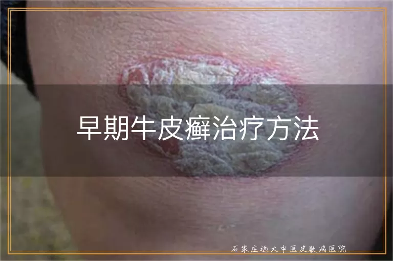 早期牛皮癣治疗方法