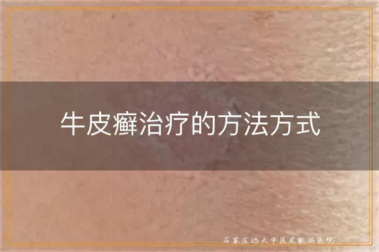 牛皮癣治疗的方法方式