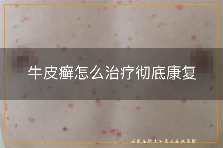 牛皮癣怎么治疗彻底康复