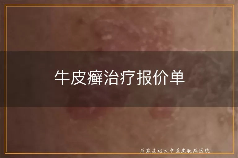 牛皮癣治疗报价单