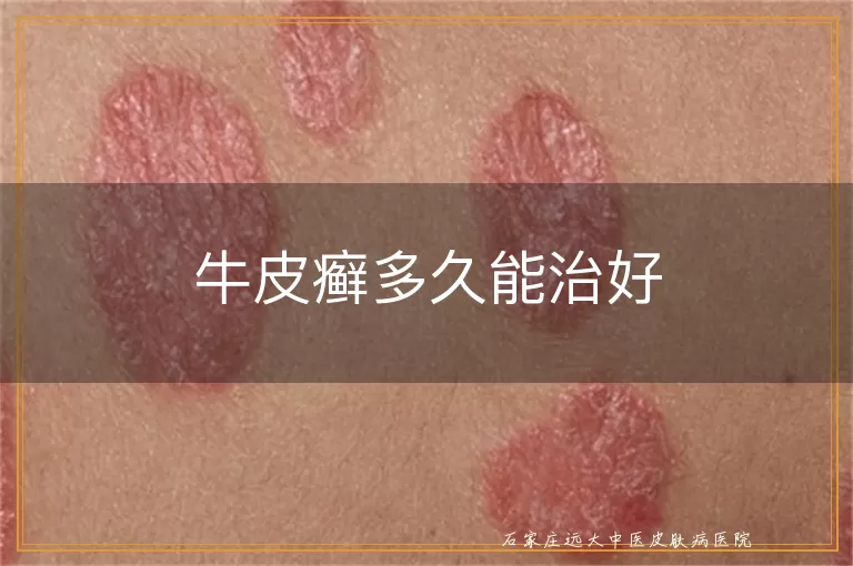 牛皮癣多久能治好