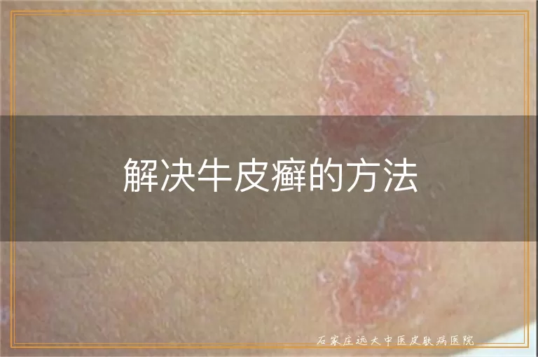 解决牛皮癣的方法