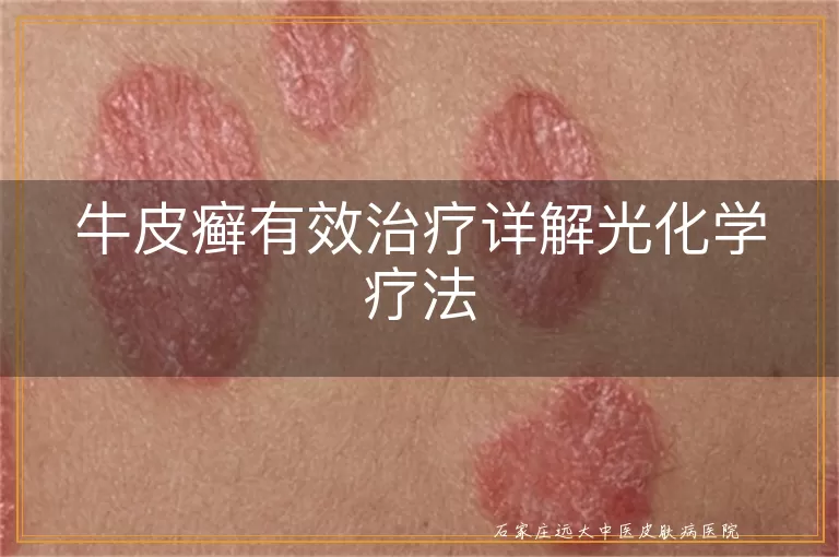 牛皮癣有效治疗详解光化学疗法