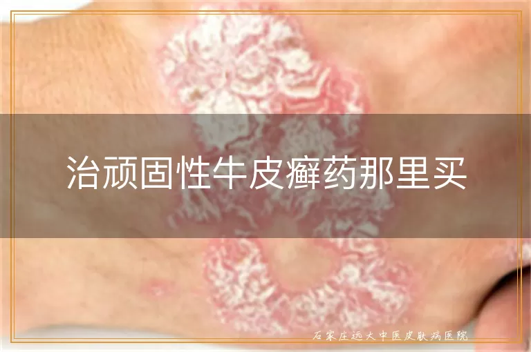 治顽固性牛皮癣药那里买