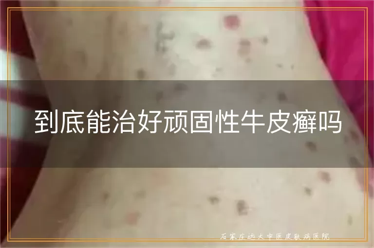 到底能治好顽固性牛皮癣吗