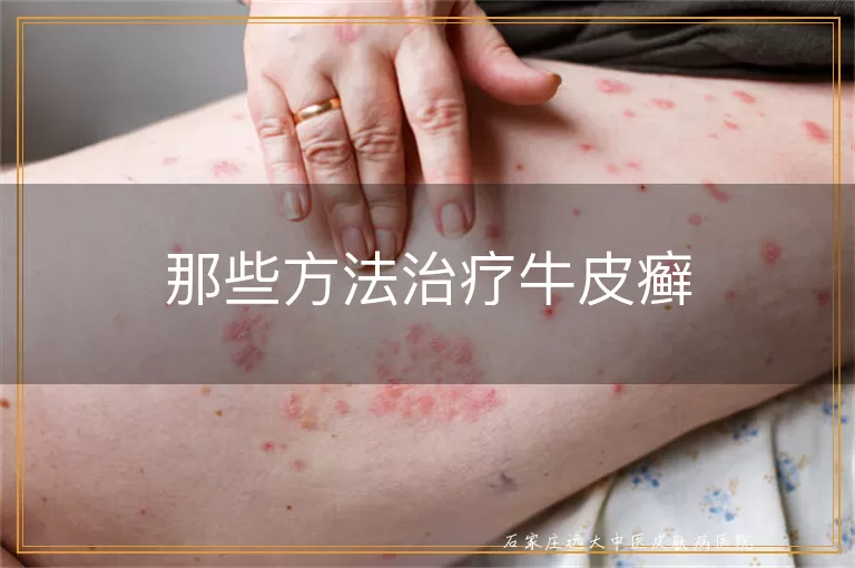 那些方法治疗牛皮癣