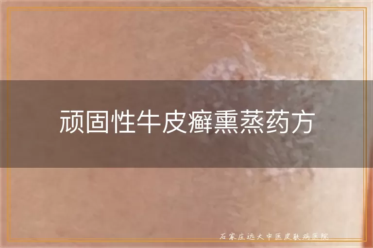 顽固性牛皮癣熏蒸药方