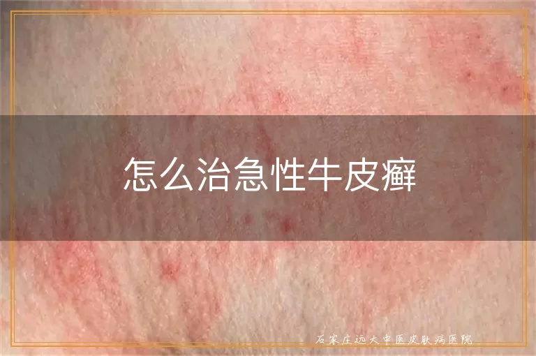 怎么治急性牛皮癣