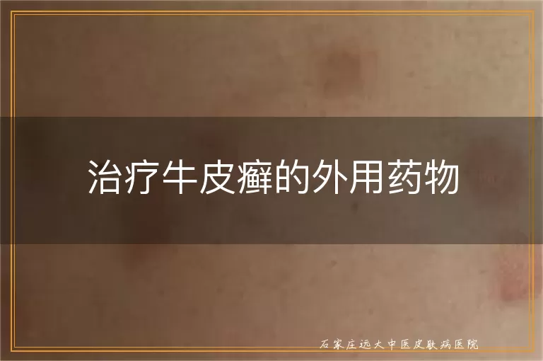 治疗牛皮癣的外用药物