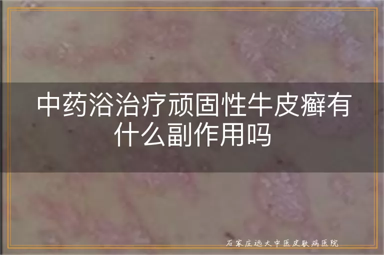 中药浴治疗顽固性牛皮癣有什么副作用吗