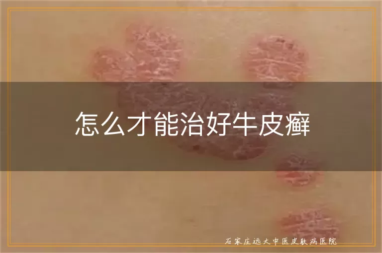 怎么才能治好牛皮癣