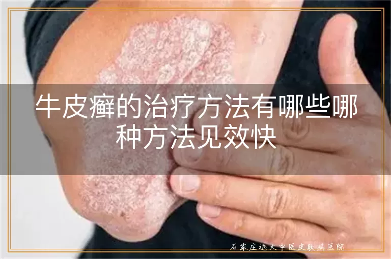 牛皮癣的治疗方法有哪些哪种方法见效快