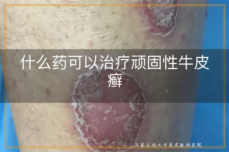 什么药可以治疗顽固性牛皮癣