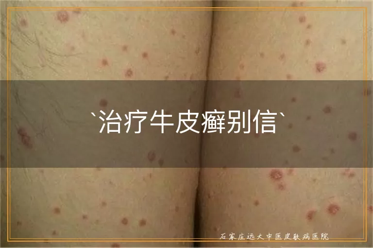 治疗牛皮癣别信