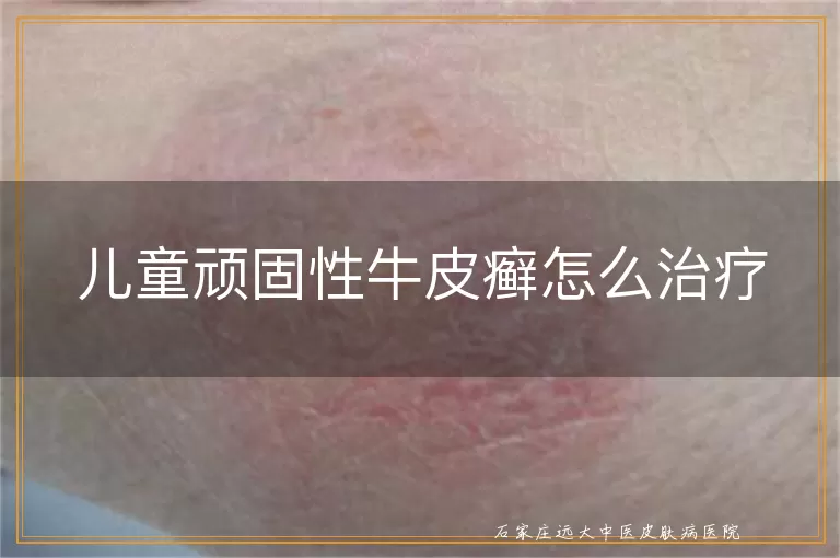 儿童顽固性牛皮癣怎么治疗