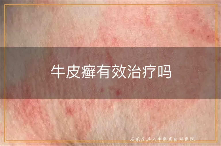牛皮癣有效治疗吗