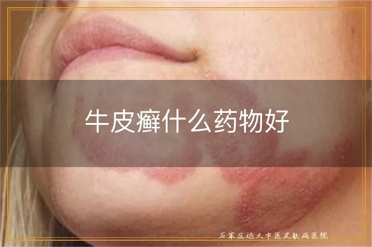 牛皮癣什么药物好