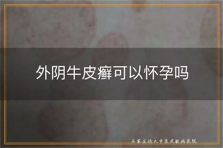 外阴牛皮癣可以怀孕吗
