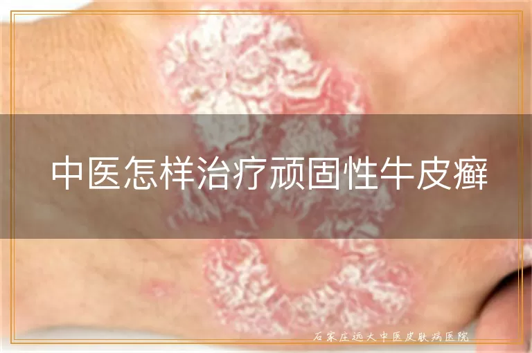 中医怎样治疗顽固性牛皮癣