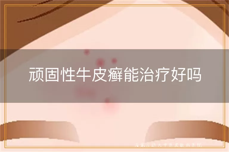 顽固性牛皮癣能治疗好吗