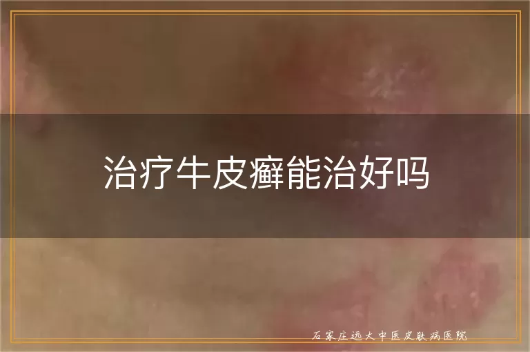 治疗牛皮癣能治好吗