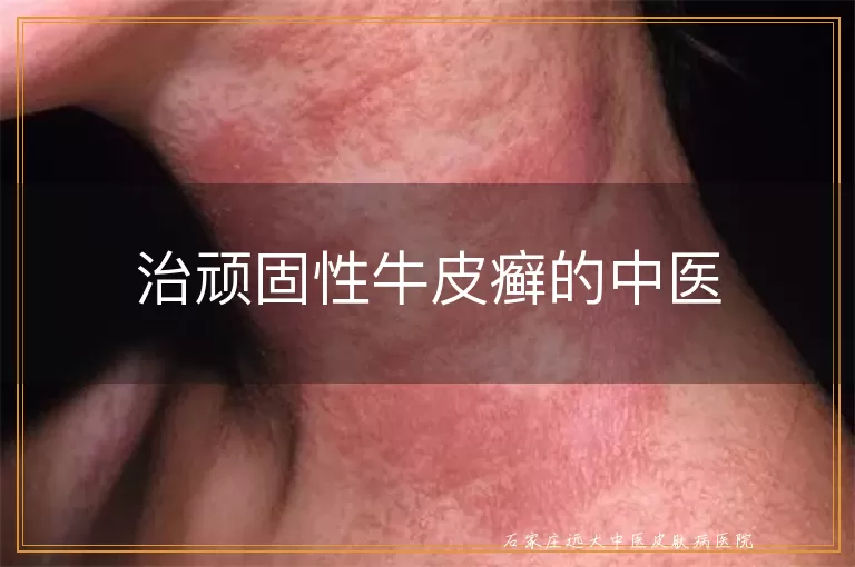 治顽固性牛皮癣的中医