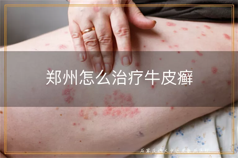 郑州怎么治疗牛皮癣