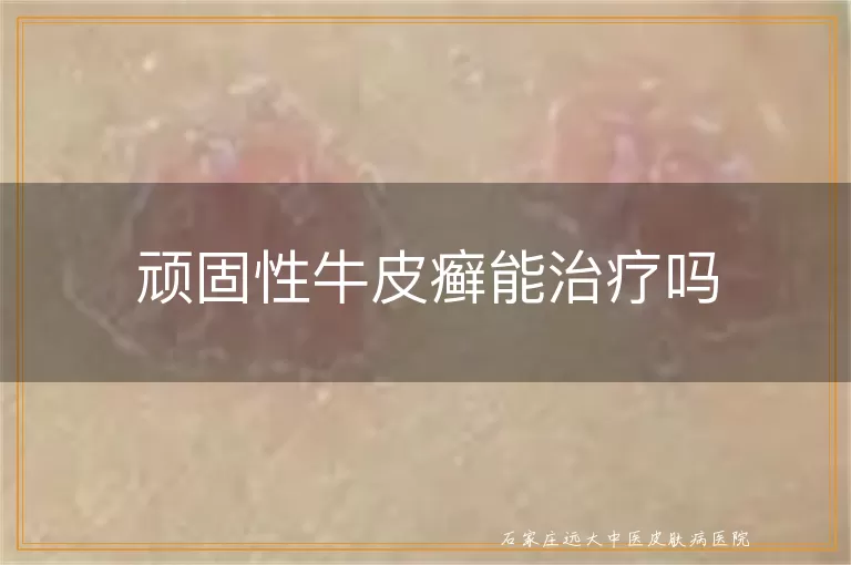 顽固性牛皮癣能治疗吗