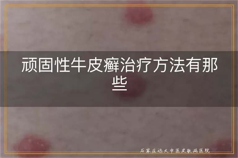 顽固性牛皮癣治疗方法有那些