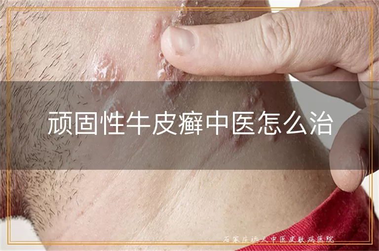 顽固性牛皮癣中医怎么治