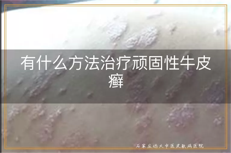 有什么方法治疗顽固性牛皮癣