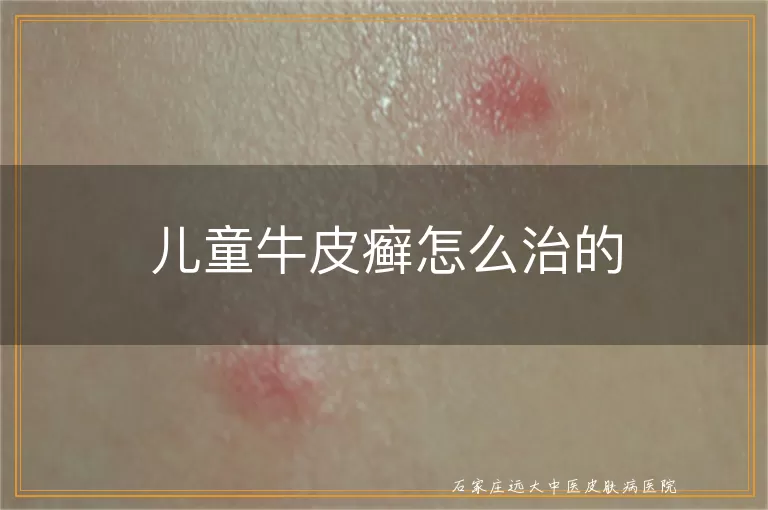 儿童牛皮癣怎么治的
