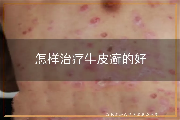 怎样治疗牛皮癣的好