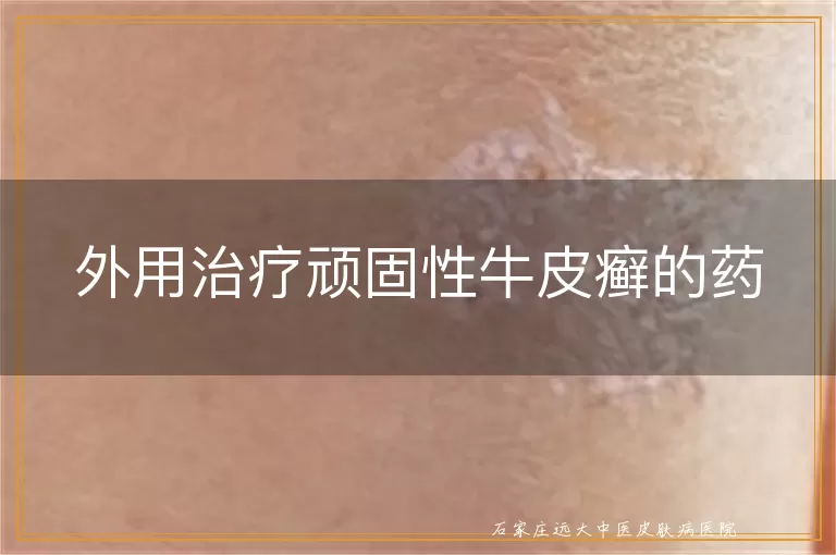 外用治疗顽固性牛皮癣的药