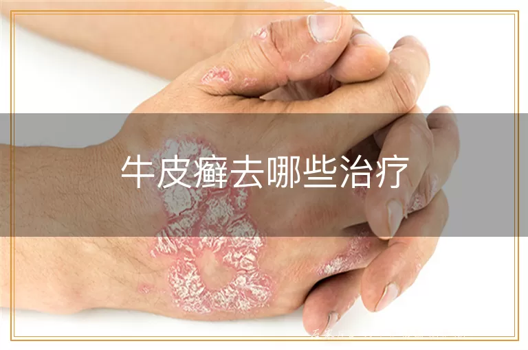 牛皮癣去哪些治疗