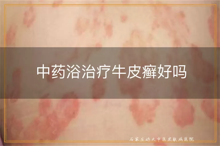 中药浴治疗牛皮癣好吗