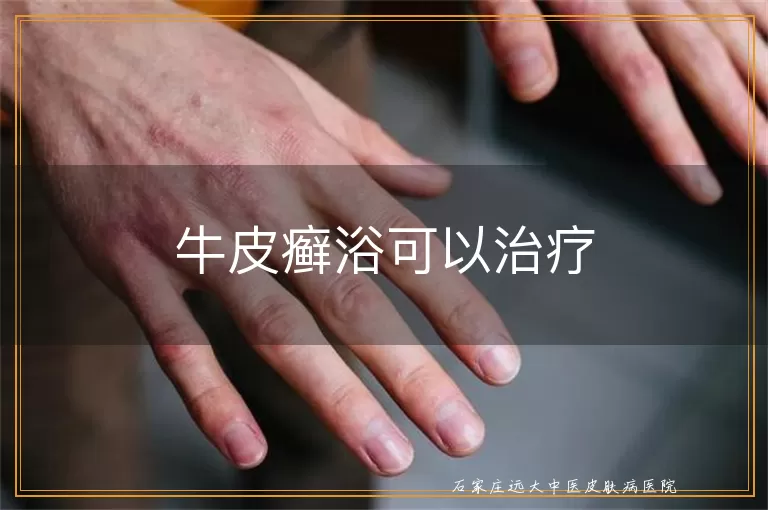 牛皮癣浴可以治疗