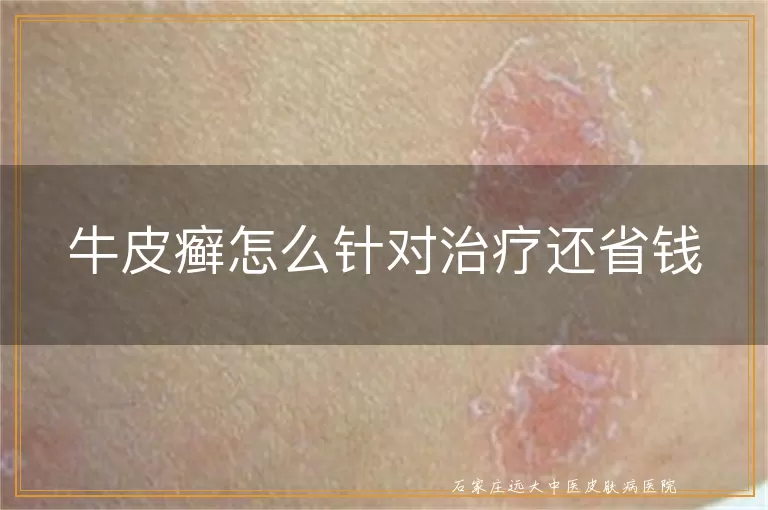 牛皮癣怎么针对治疗还省钱