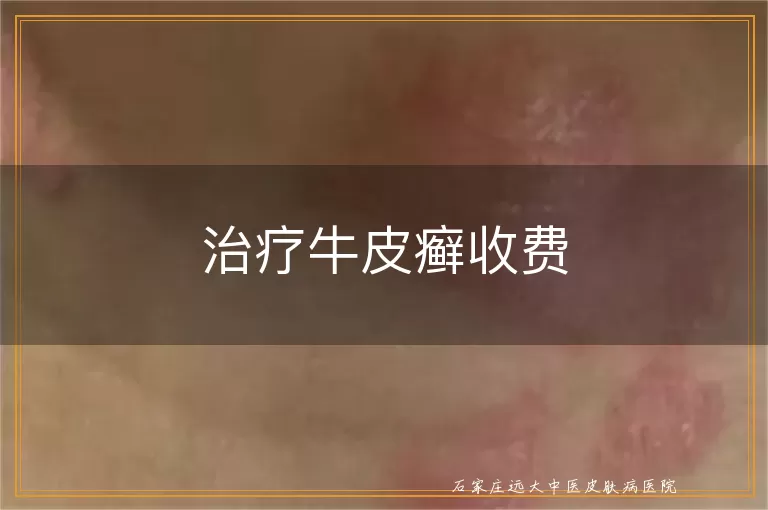 治疗牛皮癣收费